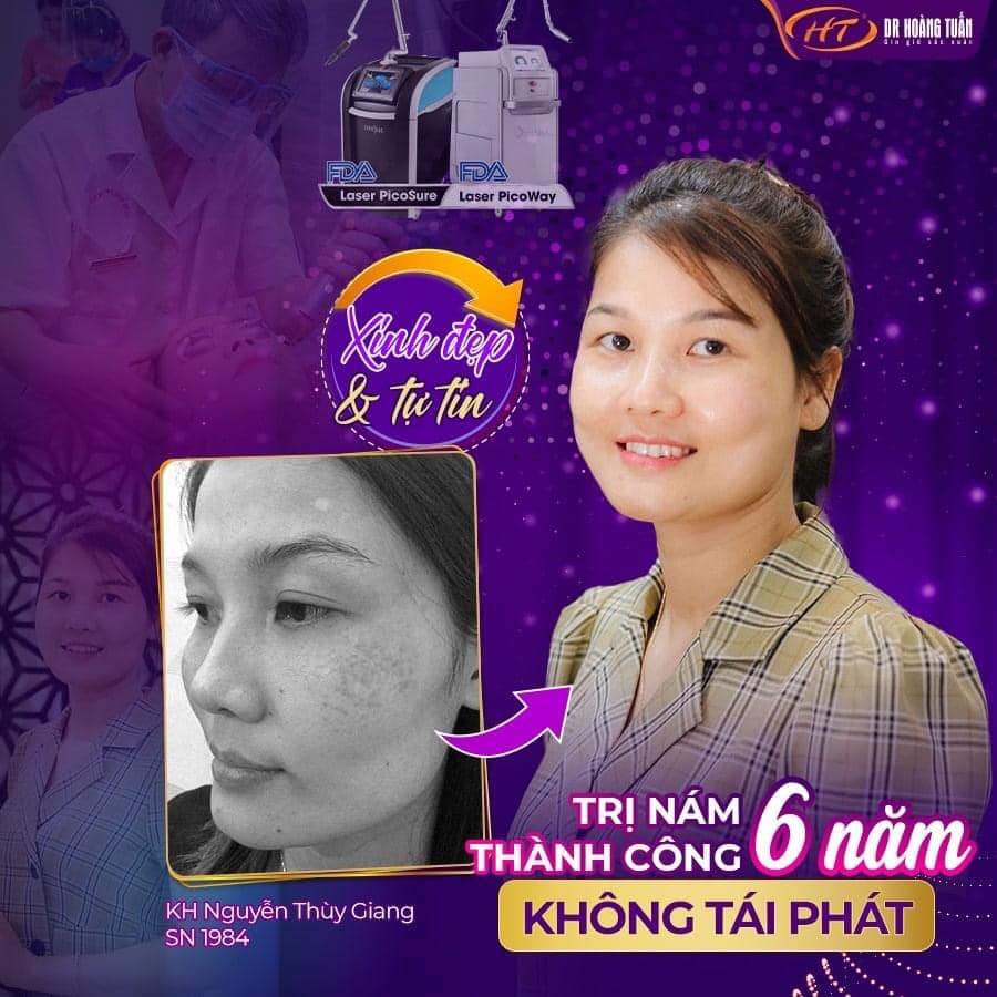 trị nám da mặt bằng laser
